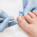 Diabetic feet | The need for proper diabetic foot care.