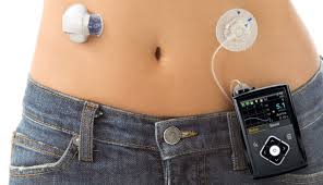 The Diabetic Pump – For a Healthier Lifestyle