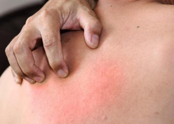 Diabetic Skin Problems: Diabetes Dry Skin