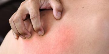 Diabetic Skin Problems: Diabetes Dry Skin