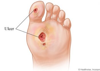 Diabetic foot ulcer – the bits you should know