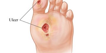 Diabetic foot ulcer – the bits you should know