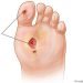 Diabetic foot ulcer – the bits you should know