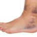 Diabetic foot problems and tips to deal with the diabetic feet